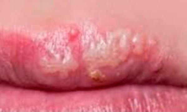 چگونه از شر زخم های سرد سریع خلاص شویم چگونه از شر زخم های سرد سریع خلاص شویم